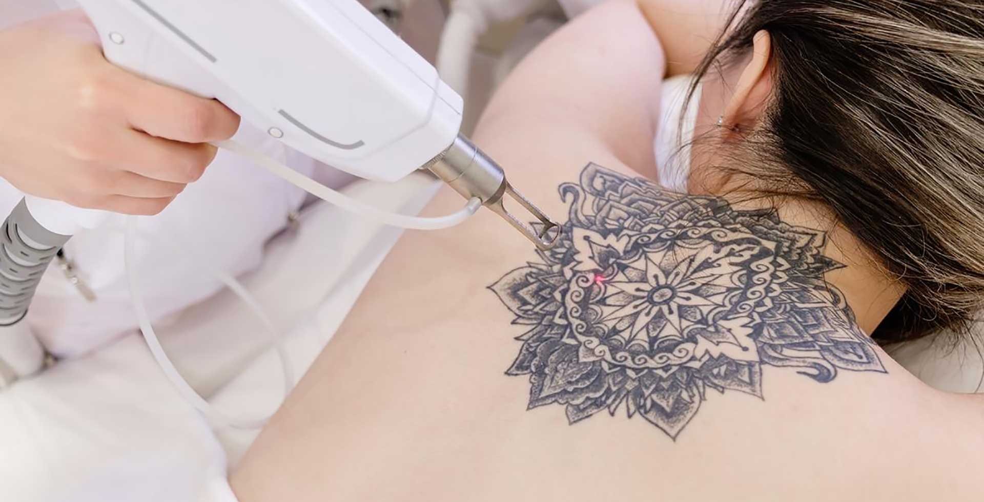 laser tattoo removal