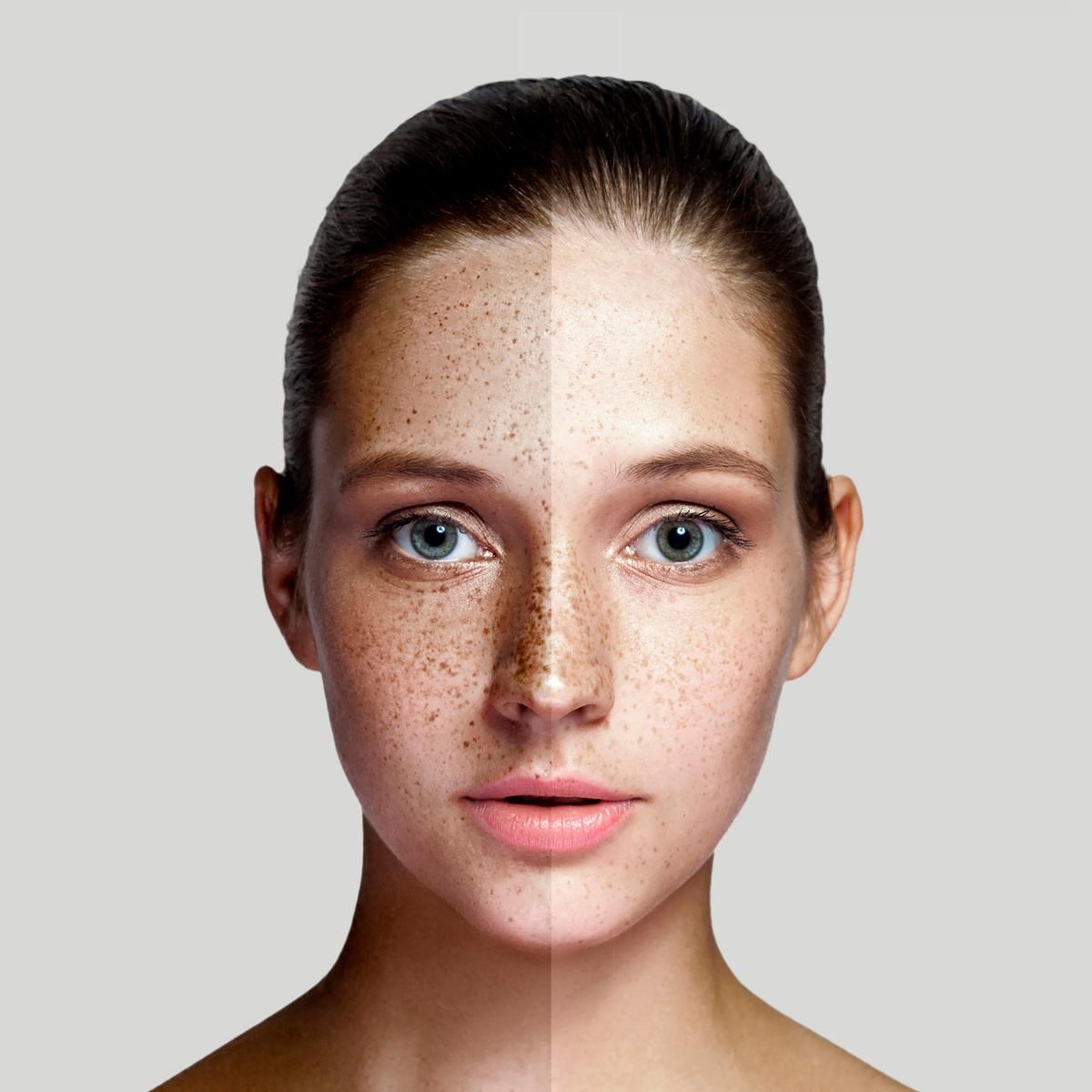 pigmentation laser