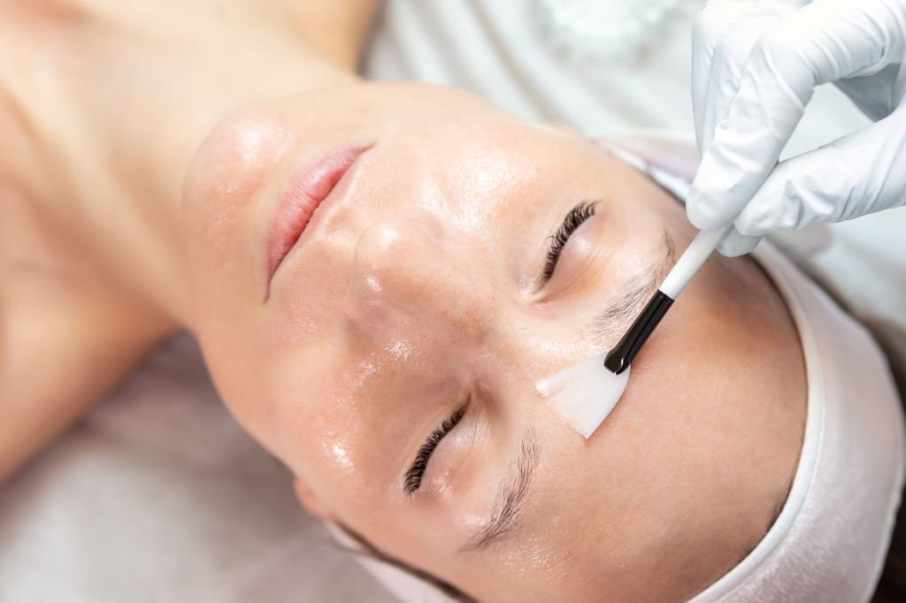 chemical face peel